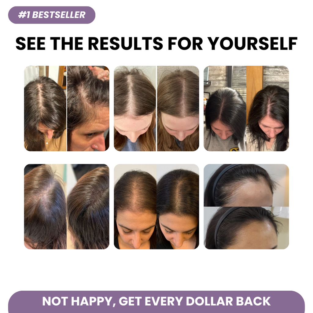 SYNO REVERA | DHT Inhibitor Formula for Hormonal Hair Loss | 1+1 FREE